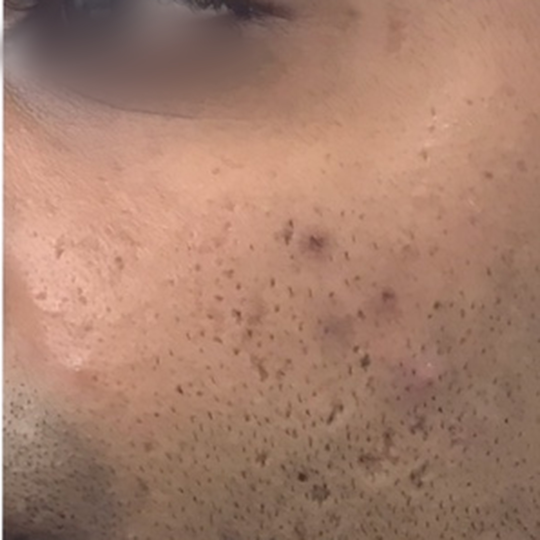 Acne & acne scars after treatment