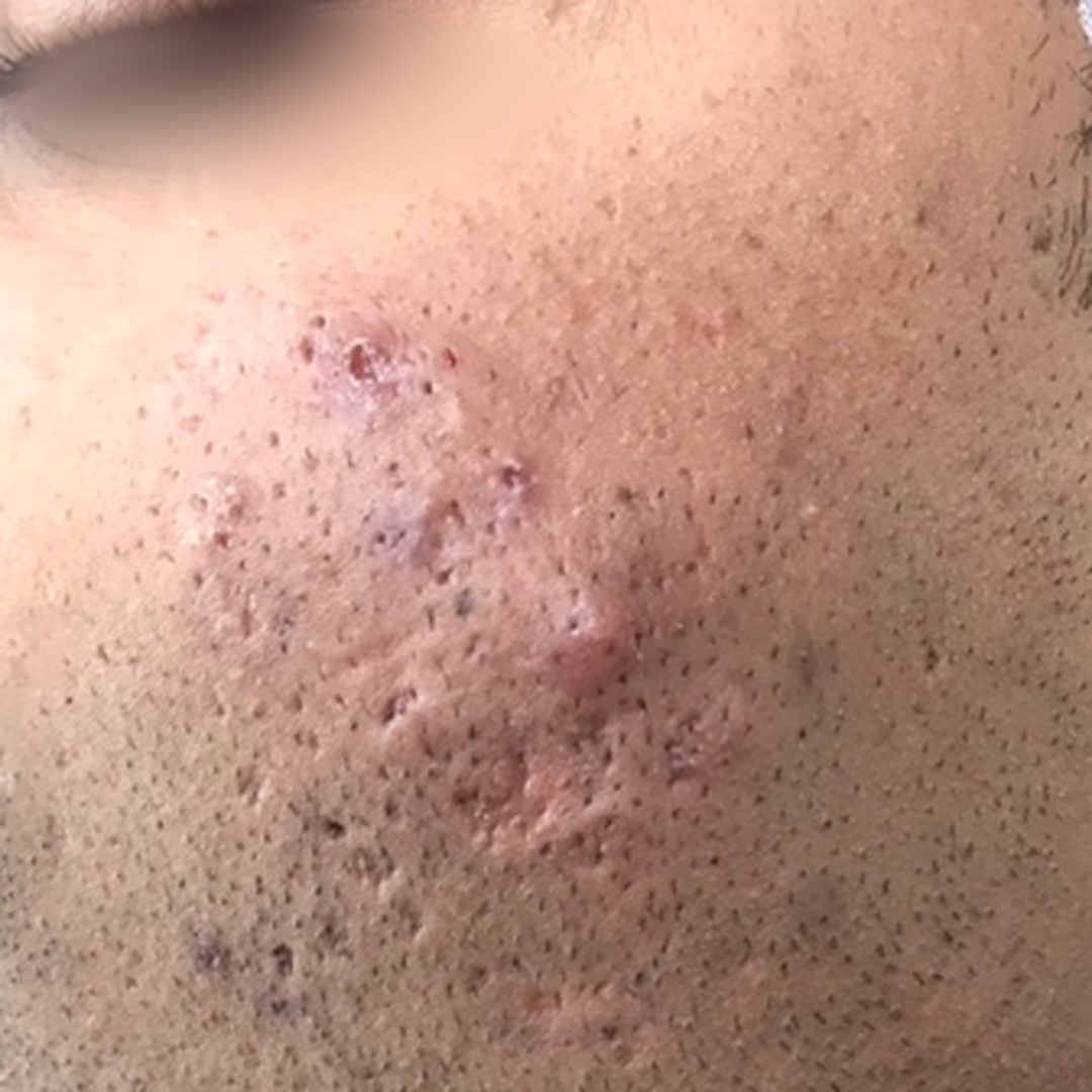 Acne & acne scars before treatment