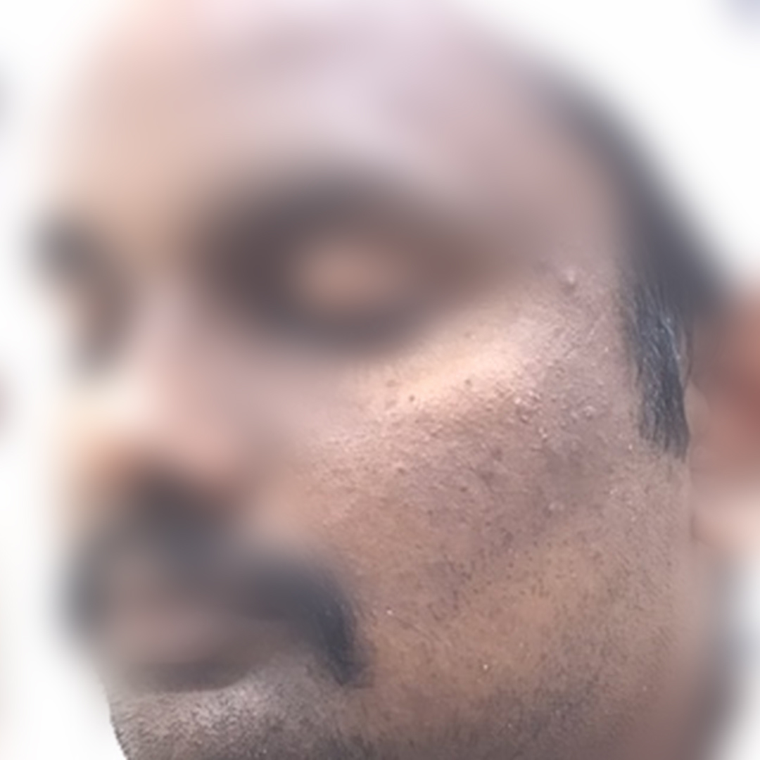 Acne & acne scars after treatment