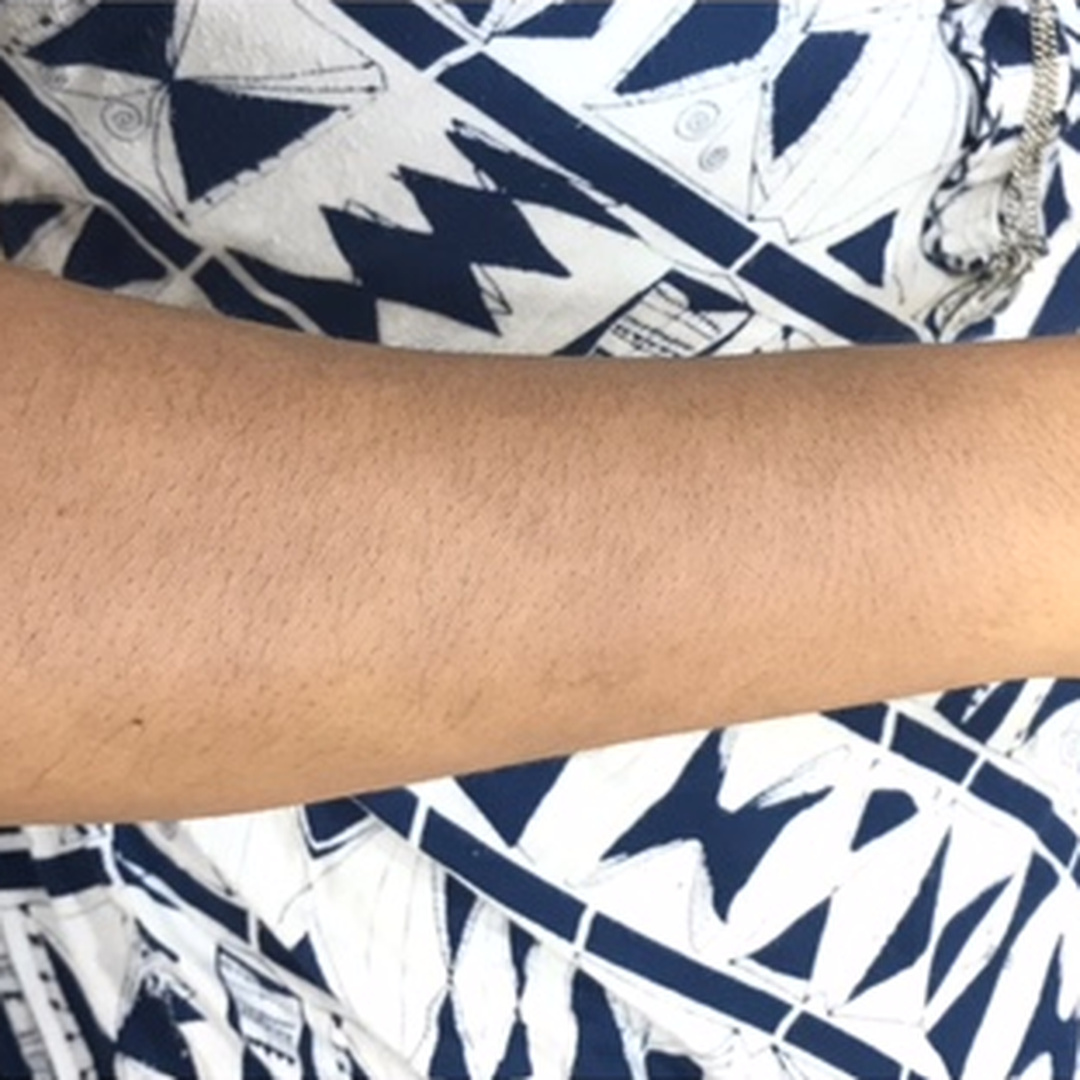 Arm pigmentation after treatment