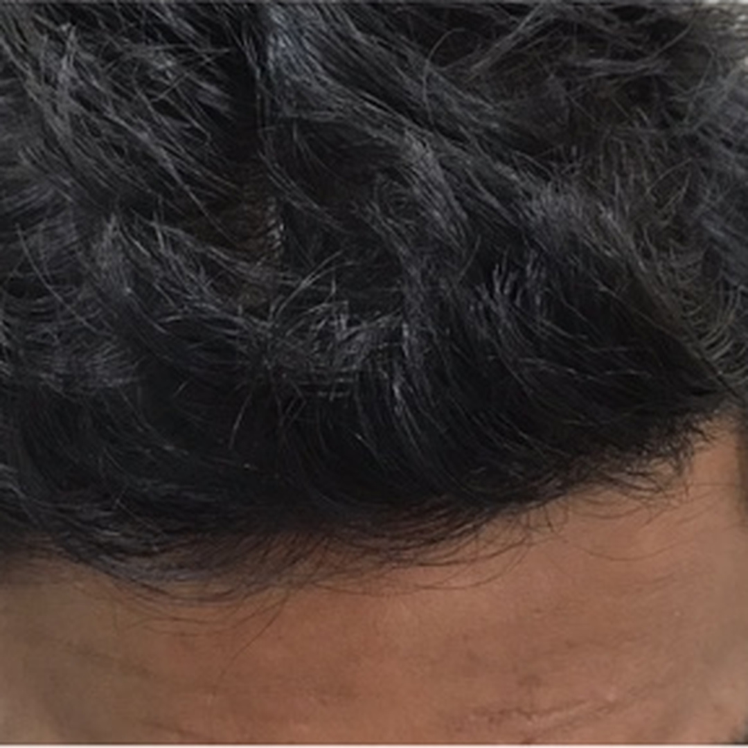 Frontal hair thinning after treatment