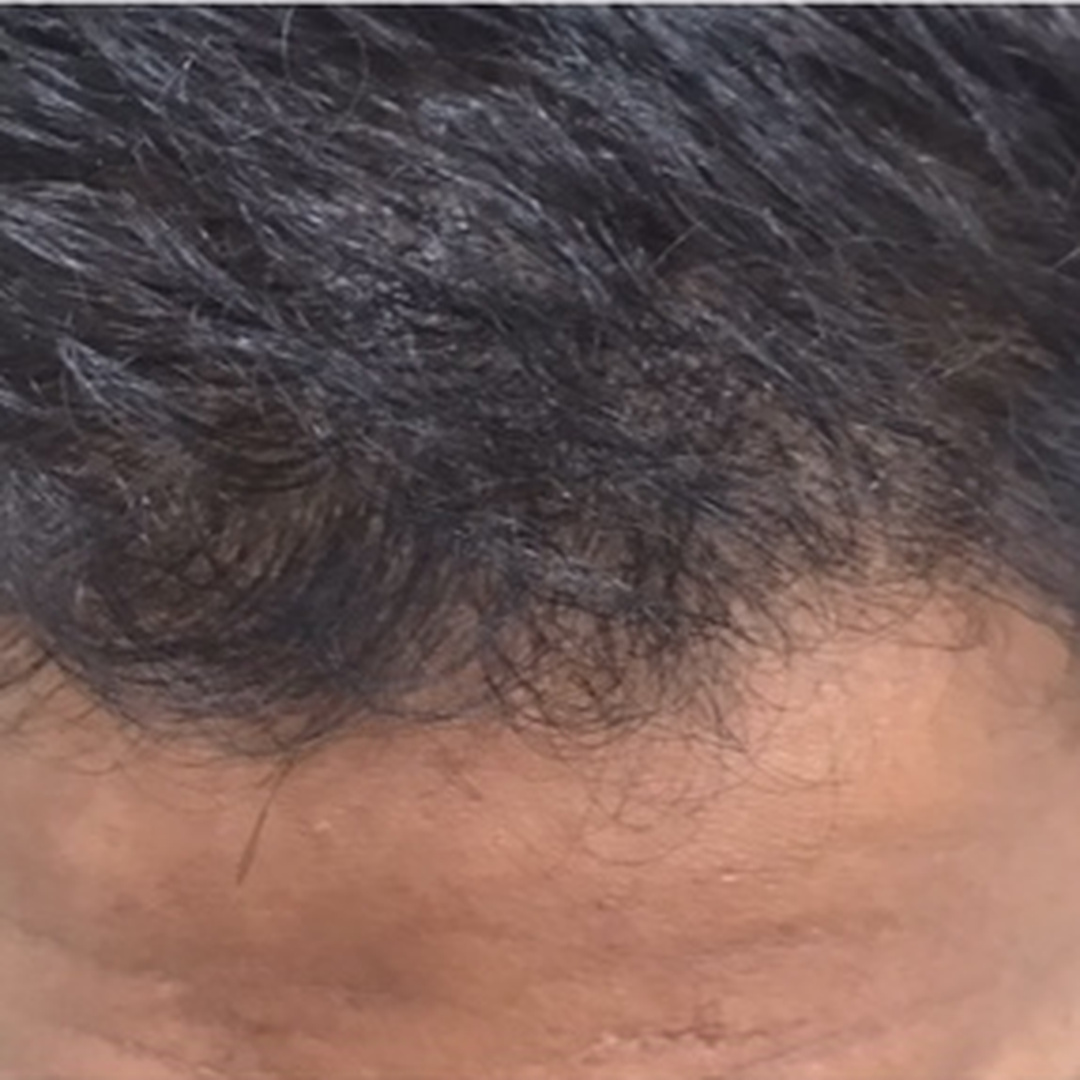 Frontal hair thinning before treatment