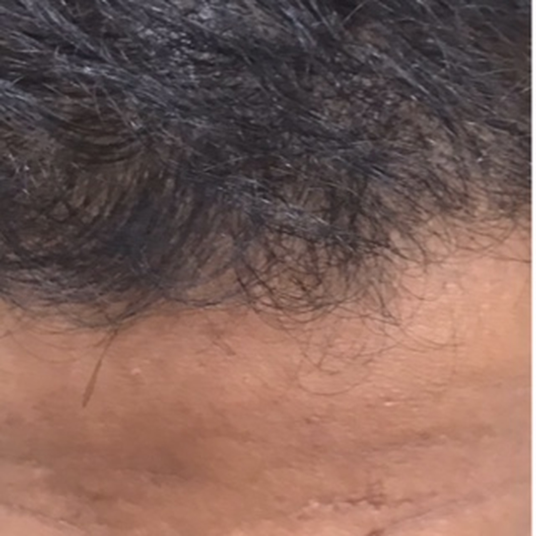 Hairline thinning before treatment