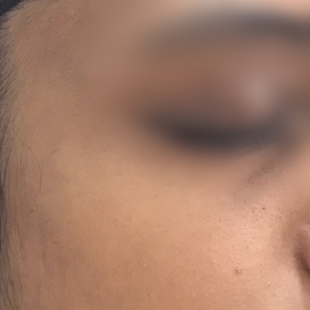 Uneven skin tone after treatment