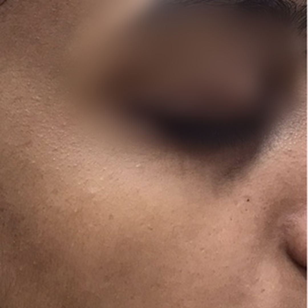 Uneven skin tone before treatment