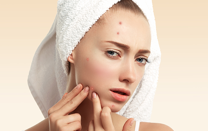 Acne/Pimples Treatment