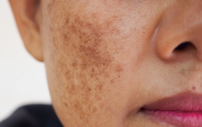 Melasma and other pigmentary disorders